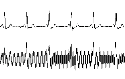 采用MSP430设计的12位心电(ECG)放大器,第7张