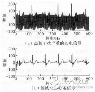 心电信号检测中滤除肌电干扰的方法解析,心电信号检测中滤除肌电干扰的方法解析,第4张