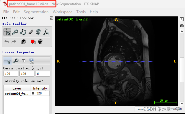 【ACDC数据集】：预处理ACDC心脏3D MRI影像数据集到VOC数据集格式，nii转为jpg，label转为png,在这里插入图片描述,第7张