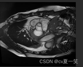 【ACDC数据集】：预处理ACDC心脏3D MRI影像数据集到VOC数据集格式，nii转为jpg，label转为png,在这里插入图片描述,第11张